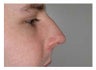 Rhinoplasty