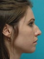 Rhinoplasty