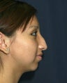 Rhinoplasty