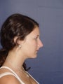 Rhinoplasty