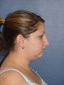 Rhinoplasty, Neck Liposuction & Chin Implant