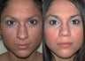 Rhinoplasty
