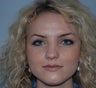 Rhinoplasty