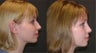 Rhinoplasty