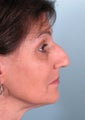 Rhinoplasty