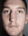Rhinoplasty