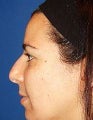 Rhinoplasty