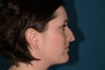 Rhinoplasty