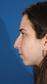 Rhinoplasty
