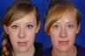 Rhinoplasty