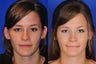 Rhinoplasty