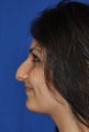 Rhinoplasty