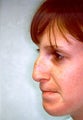 Rhinoplasty
