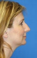Rhinoplasty