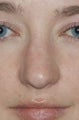 Rhinoplasty