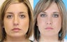 Rhinoplasty