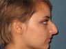 Rhinoplasty