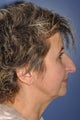 Rhinoplasty