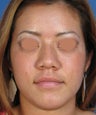 Rhinoplasty