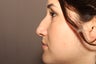 Rhinoplasty