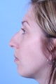 Rhinoplasty