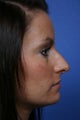 Rhinoplasty