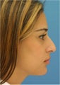 Rhinoplasty