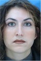 Rhinoplasty