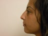 Rhinoplasty