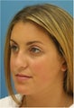 Rhinoplasty