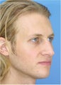 Rhinoplasty