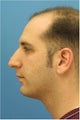 Rhinoplasty, Chin Implant