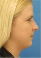 Rhinoplasty, Submental Liposuction and Buccal Fat Excision