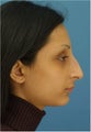 Rhinoplasty