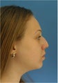 Rhinoplasty
