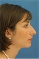 Rhinoplasty