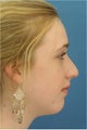 Rhinoplasty, Chin Implant