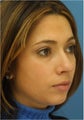 Rhinoplasty