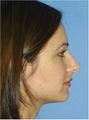Rhinoplasty