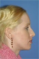Rhinoplasty, Cheek Implants