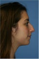 Rhinoplasty
