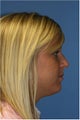 Rhinoplasty