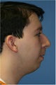 Rhinoplasty, Chin Implant, Submental Liposuction, Otoplasty