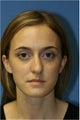 Rhinoplasty