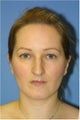 Rhinoplasty