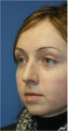 Rhinoplasty