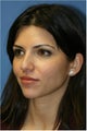 Rhinoplasty