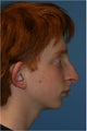 Rhinoplasty