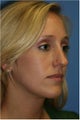 Rhinoplasty