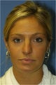 Rhinoplasty